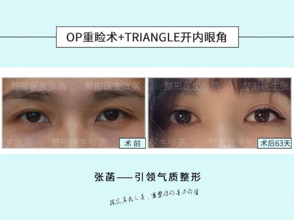 埋線雙眼皮、韓式三點及菡式OP重瞼術哪種方式更適合你吶?