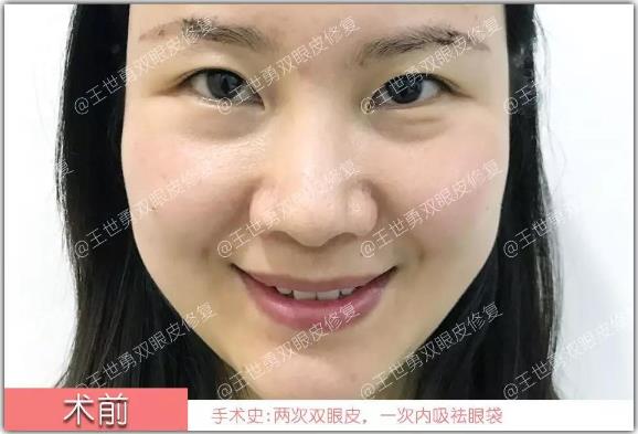 【王世勇】雙眼皮(初眼)案例分享讓自己看到更美的自己