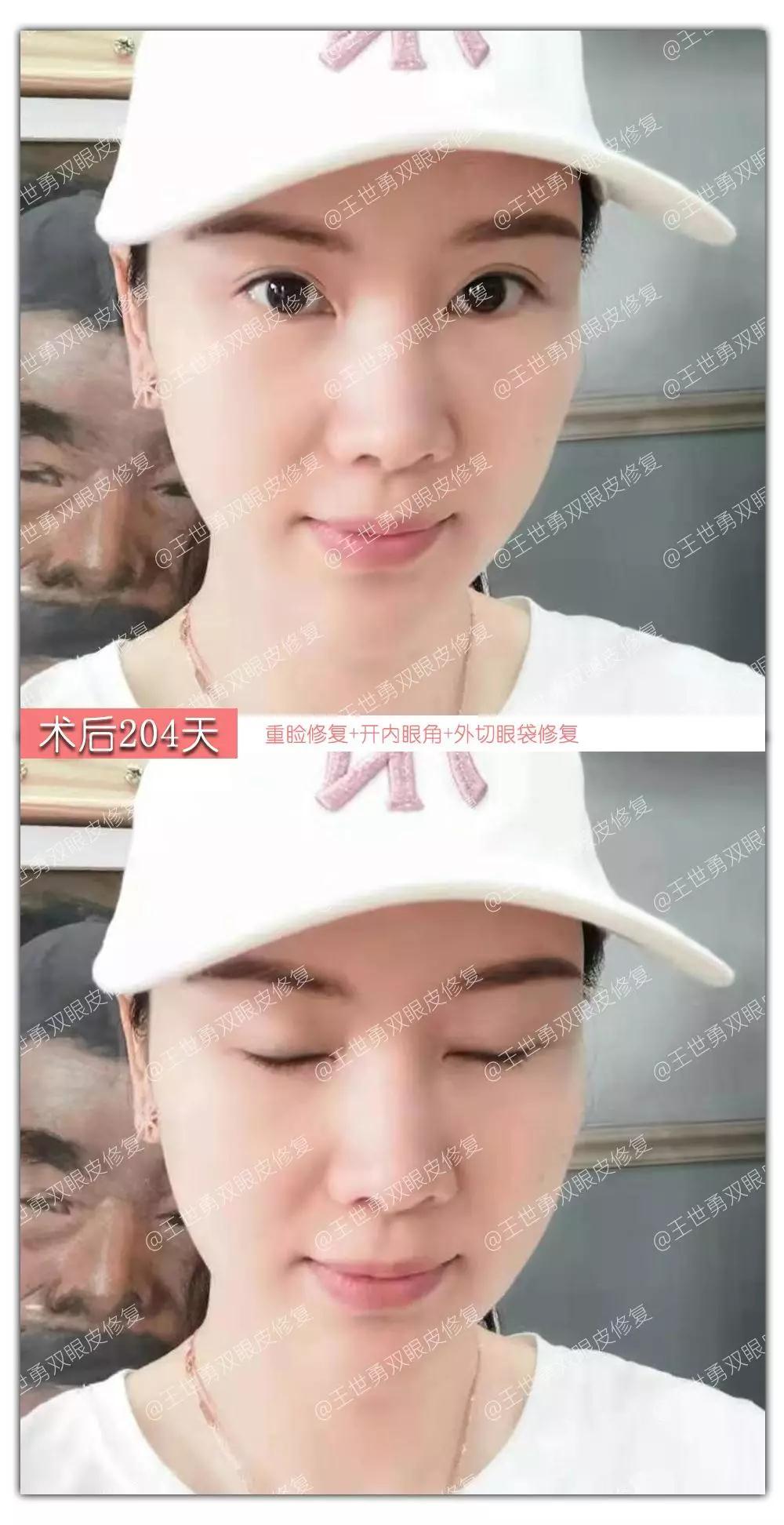 【王世勇】雙眼皮(初眼)案例分享讓自己看到更美的自己