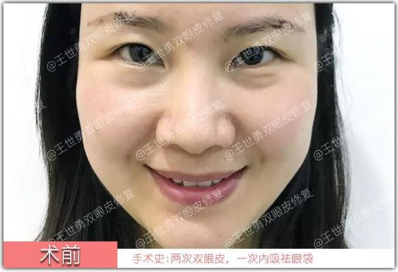 【王世勇】雙眼皮(初眼)案例分享讓自己看到更美的自己