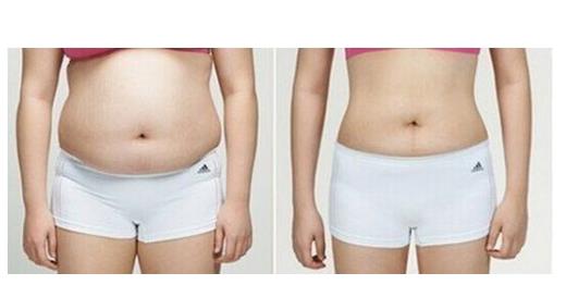 埋線減肥 中醫埋線就能想瘦就瘦?獨特減肥方法