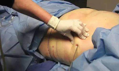 醫學減肥與藥物減肥有哪些區別