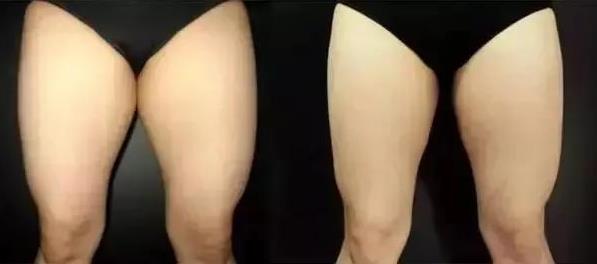 武漢藝星整形醫(yī)院:6月22-28日酷塑減脂專場,讓你輕輕松松的減肥!