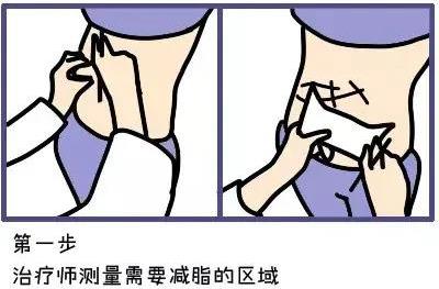 武漢藝星整形醫(yī)院:6月22-28日酷塑減脂專場,讓你輕輕松松的減肥!