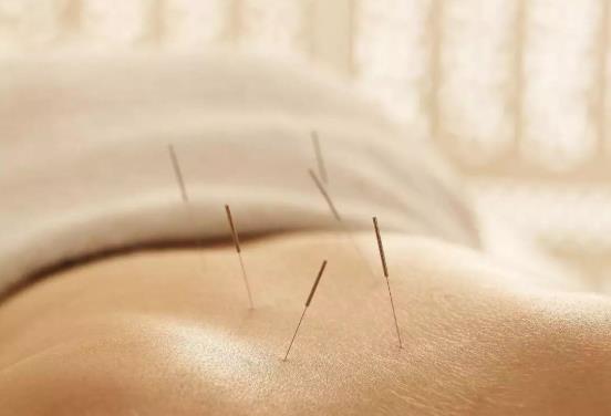 針灸減肥每天都要扎嗎?針灸減肥和埋線減肥的區別