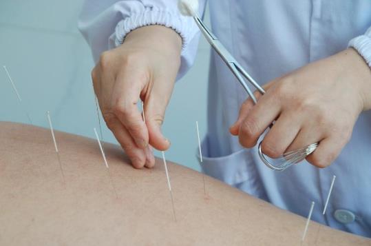 針灸減肥每天都要扎嗎?針灸減肥和埋線減肥的區別