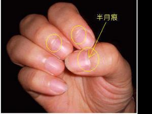 指甲上的半月痕你懂多少？指甲半月痕與健康吉兇