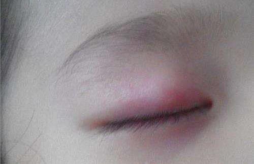 引發上眼皮腫的原因之長針眼.jpg