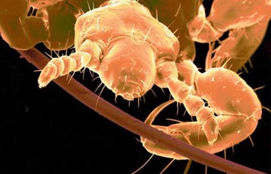 頭上長虱子怎么辦?虱子怎么去除?去虱子和虱子卵的有效方法