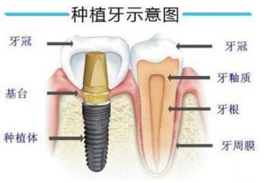 長沙種植牙哪家好,長沙德韓口腔專業嗎?