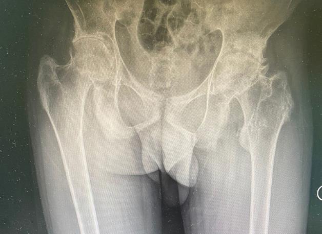 合川宏仁醫院骨科為4年疼痛的22歲小伙成功實施雙髖關節置換術