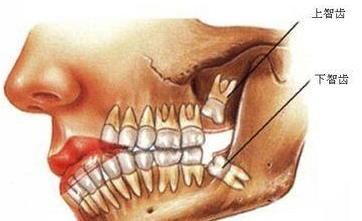 發炎疼痛的智齒為什么不能立刻拔掉?智齒一定要拔嗎?