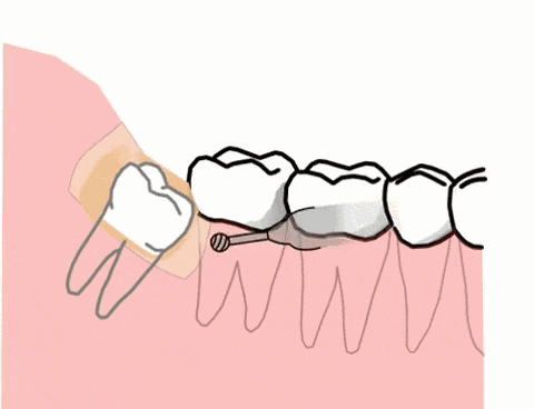 發炎疼痛的智齒為什么不能立刻拔掉?智齒一定要拔嗎?