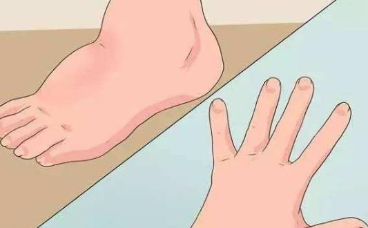 一覺醒來,身體浮腫,浮腫只是因?yàn)樗昂人畣幔? border=