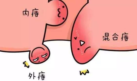 痔瘡有哪些分類?哪些人容易患痔瘡?
