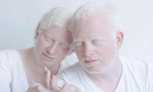 白化病有哪些癥狀?白化病是先天形成還是后天形成的?