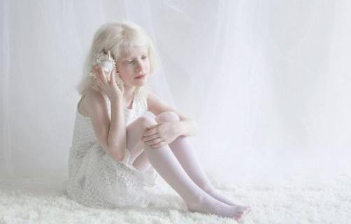 白化病和哪些疾病相似?白化病和白癜風有哪些區別?