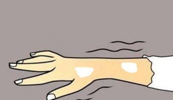 哪些人容易患白癜風?患白癜風的早期癥狀有哪些?
