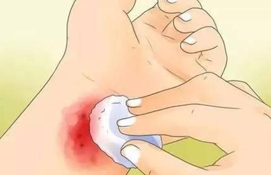 哪些人容易患白癜風?患白癜風的早期癥狀有哪些?