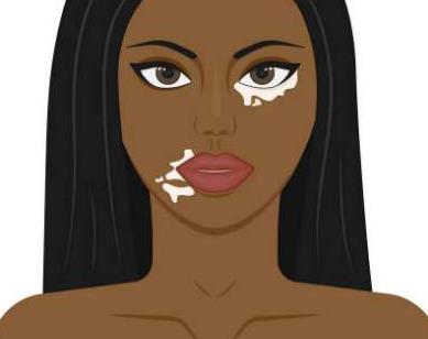 哪些人容易患白癜風?患白癜風的早期癥狀有哪些?