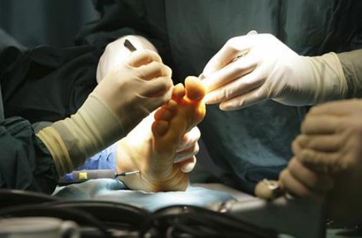 患了雞眼怎么辦?雞眼怎么治療?