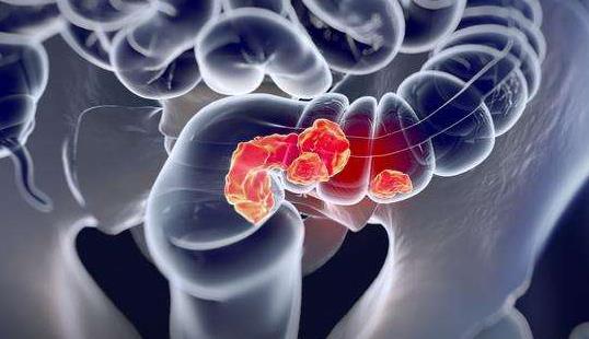 直腸癌有哪些治療方式?直腸癌的飲食注意事項有哪些?