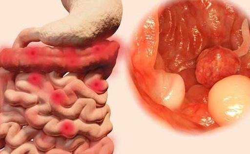 直腸癌有哪些治療方式?直腸癌的飲食注意事項有哪些?