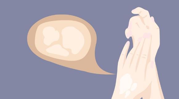 患白癜風的病因有哪些?怎么預防白癜風?