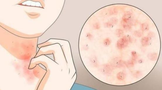 螨蟲過敏有哪些癥狀?螨蟲過敏有哪些危害?