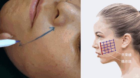 中家醫整形23周年慶帶你了解做線雕6大優勢和效果!