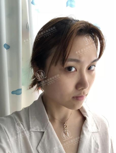 中家醫整形23周年慶帶你了解做線雕6大優勢和效果!