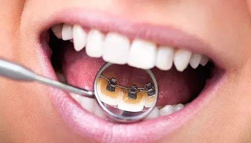 全民矯牙公益行動 那種牙套適合自己