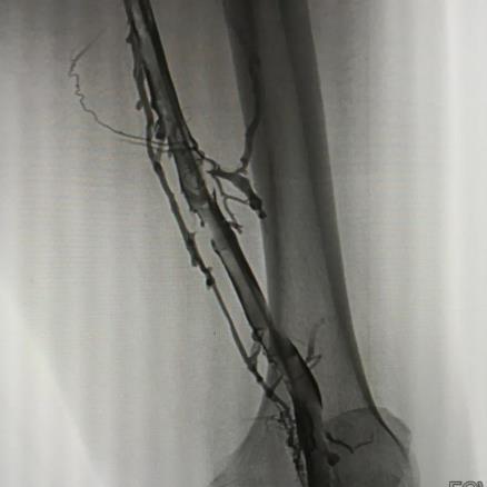 案例 大腿腫脹來勢洶洶,合川宏仁醫院醫生及時救治,消失匆匆!