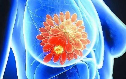 什么是小葉增生?小葉增生的人不要吃什么?