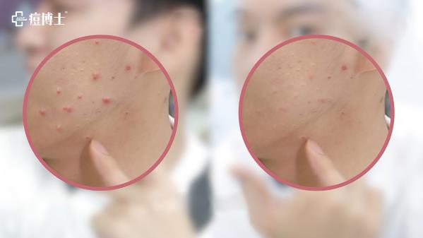 紅人探店||擁有五百萬粉絲的他是如何祛痘的?