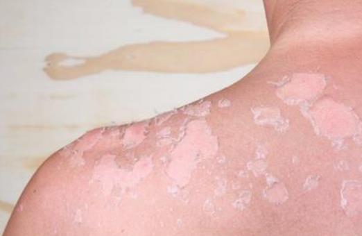 油性皮膚有好處嗎?油性皮膚怎么改善?