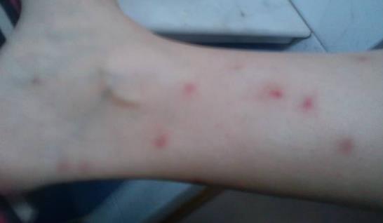 家里有跳蚤怎么辦?身上抹什么跳蚤不會咬?