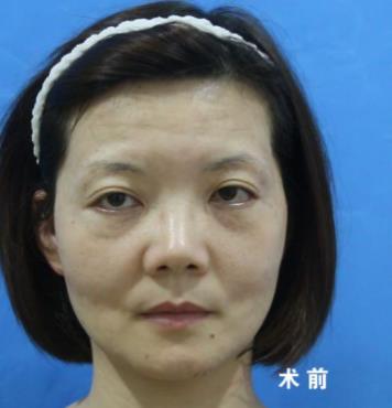福州名韓整形徐麗麗:早點做脂肪膠填充的好處