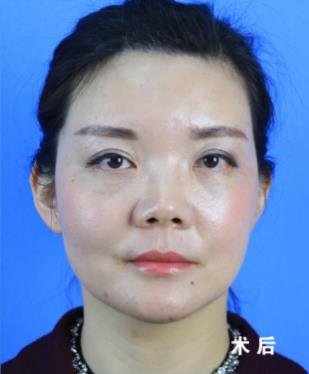福州名韓整形徐麗麗:早點做脂肪膠填充的好處