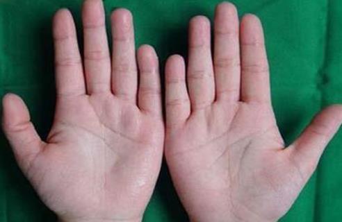 手汗癥能自愈嗎?得了手汗癥該怎么辦