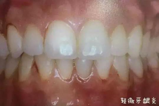 為什么說牙病要及時醫治——全民愛牙公益行動