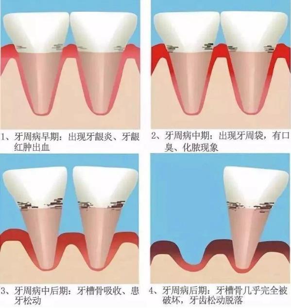 為什么說牙病要及時醫治——全民愛牙公益行動