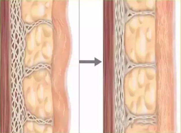 抗衰醫生宋超超:提升面部脂肪墊和SMAS筋膜層的優勢