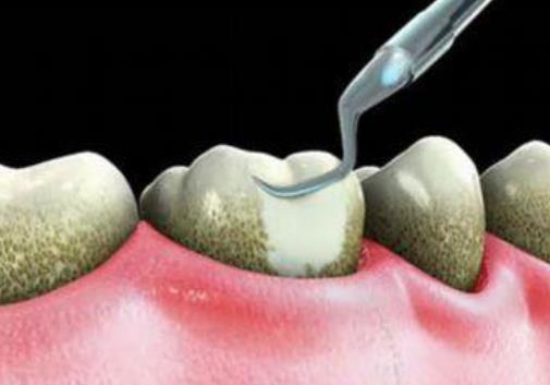 牙結石可以自己扣掉嗎?牙結石怎么才可除去?