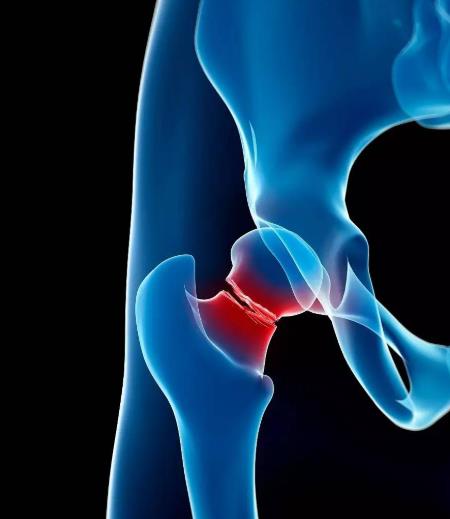 做完骨折手術能吃帶魚嗎?做完骨折手術要注意什么事項