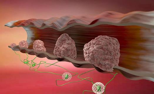 怎么可以檢查除直腸息肉?怎么預防直腸息肉?