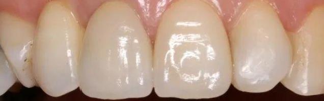 廣東省全民愛牙行動(dòng) 給大家講一下瓷貼面美學(xué)修復(fù)~