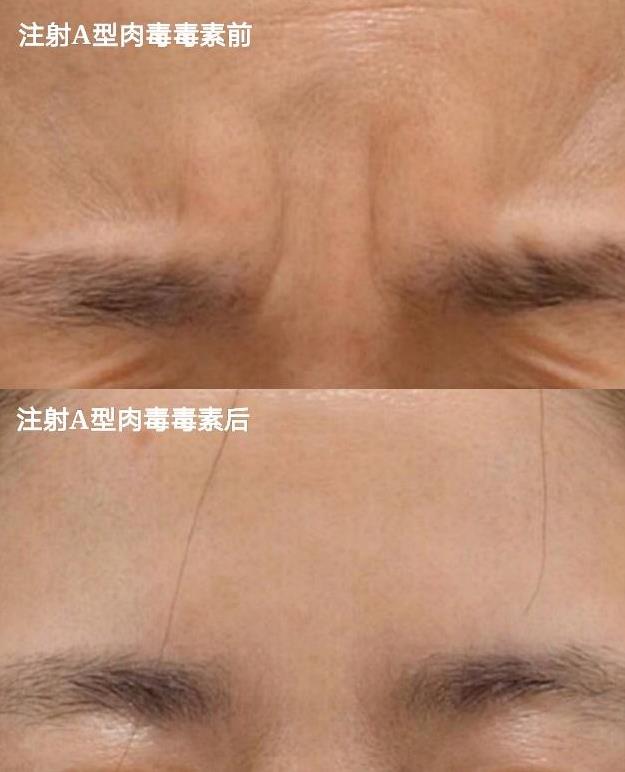 怕痛怕動刀?王的整形楊汝教你午休一刻搞定微整形