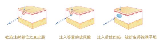 怕痛怕動刀?王的整形楊汝教你午休一刻搞定微整形