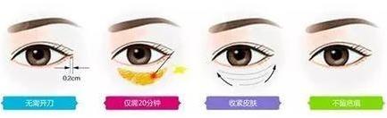 京典麗園去眼袋不開刀提升眼值告別眼袋的煩惱